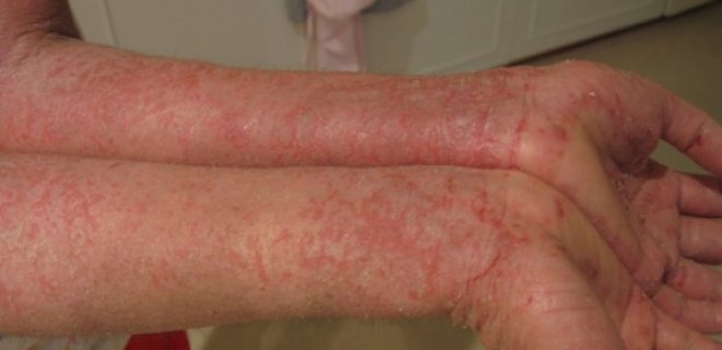 egzama - Kimyasallara maruz kalan işçi: Psikolojik ve fiziksel olarak sağlıklı bir hayat yaşayamıyorum